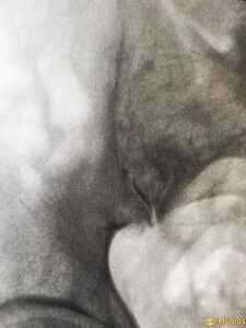 Infiltración de la articulación sacroiliaca izquierda.
