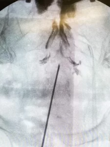 Procedimiento de Epidural caudal (visión anteroposterior)