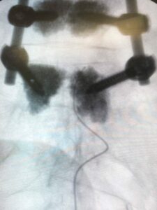 Procedimiento de Radiofrecuencia intracanal de ganglio de la raíz dorsal de L5 derecha tras artrodesis lumbar