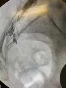 Procedimiento de Epidural caudal (visión lateral)