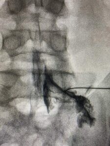 Epidural transforaminal L5 derecha